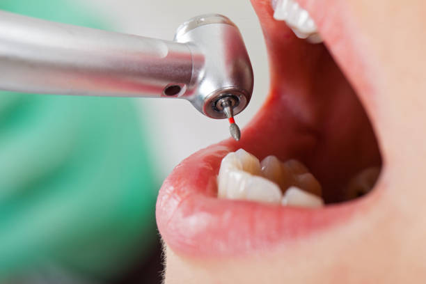 Best Emergency Tooth Extraction in Greybull, WY